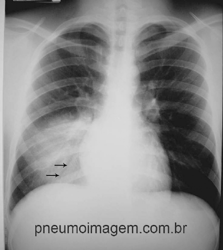 ATS LAN�A GUIA DE BOLSO DAS DIRETRIZES PARA PNEUMONIA ADQUIRIDA NA COMUNIDADE: FA�A O DOWNLOAD